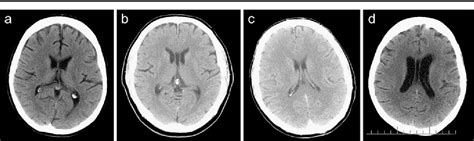 [PDF] Cavum velum interpositum, cavum septum pellucidum and cavum Vergae: a review | Semantic ...