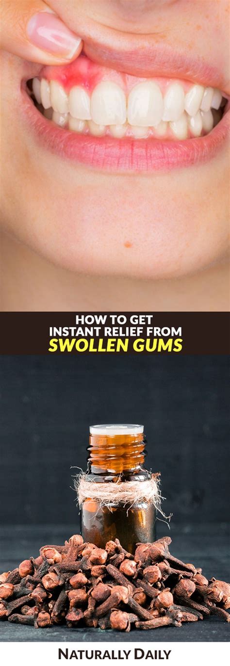 Home Remedies for Swollen Gums for Instant Relief #homeremediesforswollengums #swollengums # ...