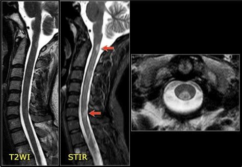 The Radiology Assistant : Myelopathy