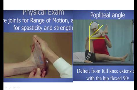 Assessment of Pathological Gait — OrthopaedicPrinciples.com