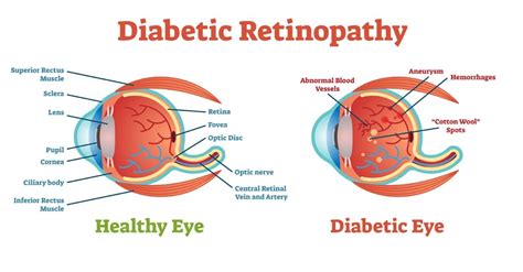 What is Diabetic Retinopathy?