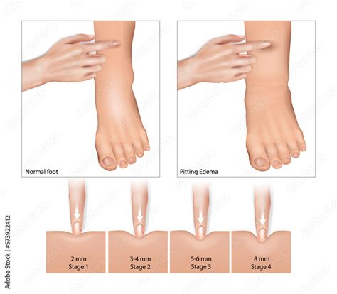 Pitting Edema and Normal foot. Oedema, fluid retention, water retention, dropsy, hydropsy ...