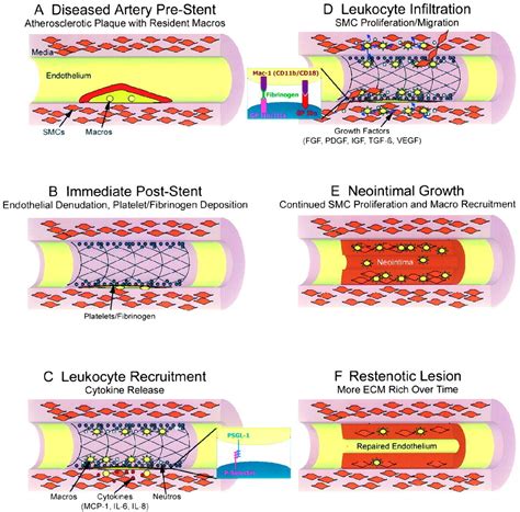 Inflammation and Restenosis in the Stent Era | Arteriosclerosis, Thrombosis, and Vascular Biology