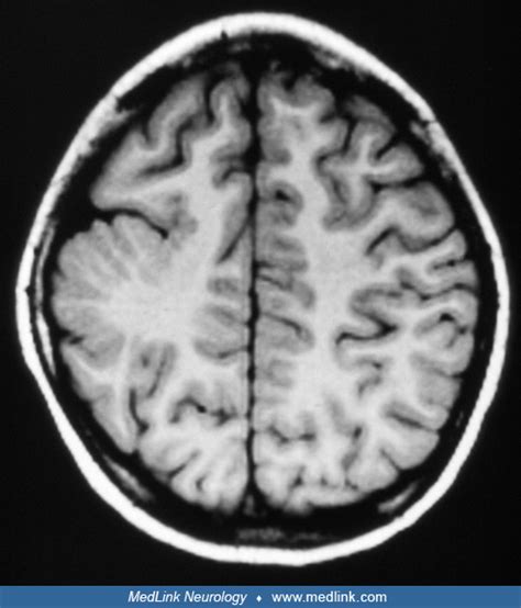 Schizencephaly | MedLink Neurology