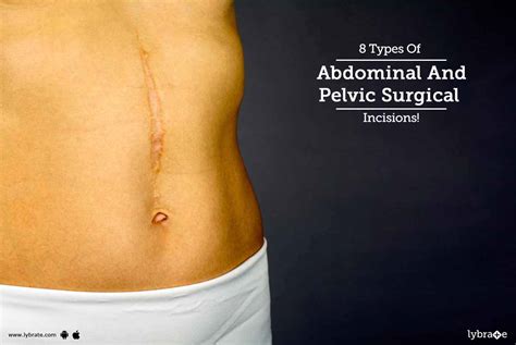 8 Types Of Abdominal And Pelvic Surgical Incisions! - By Dr. Ajay Gupta | Lybrate