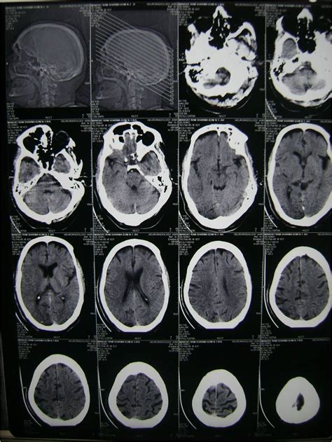 Read the NCCT correctly | Science of Neurointervention