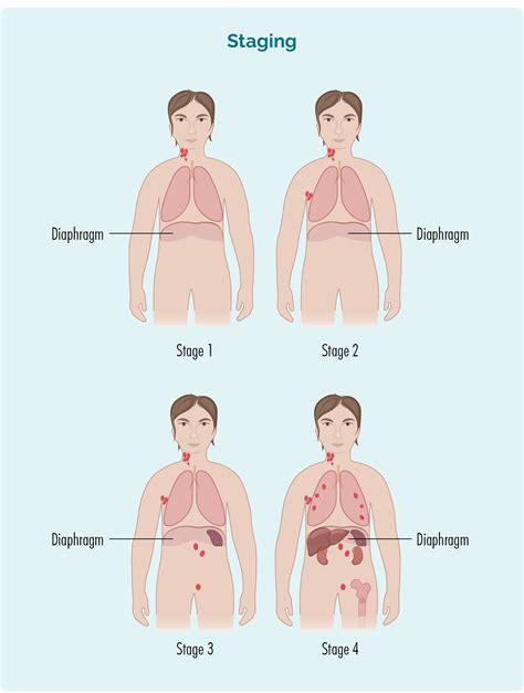 Non-Hodgkin Lymphoma (NHL) - Lymphoma Australia