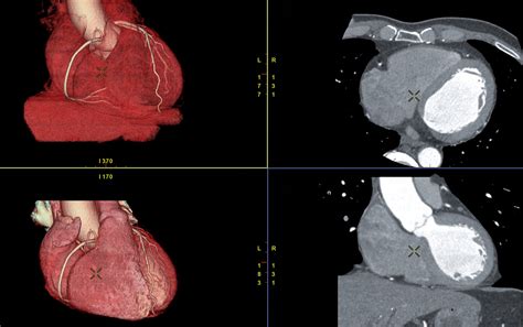 CT Coronary Angiogram — Hurstville Private Heart Centre · Cardiology ...