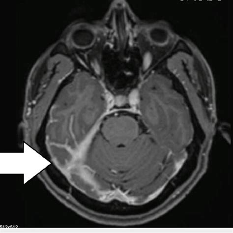 MRI of the brain: T1 axial contrast showing contrast enhancement in the... | Download Scientific ...