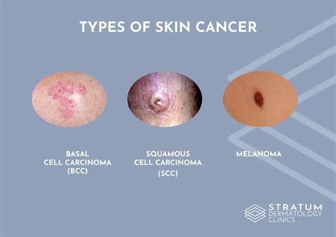 Skin Cancer Types Squamous Cell Carcinoma