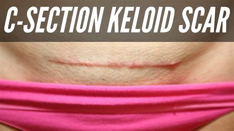 C Section Scar Keloid | DOES C-SECTION SCAR MASSAGE CAUSE KELOID? - YouTube