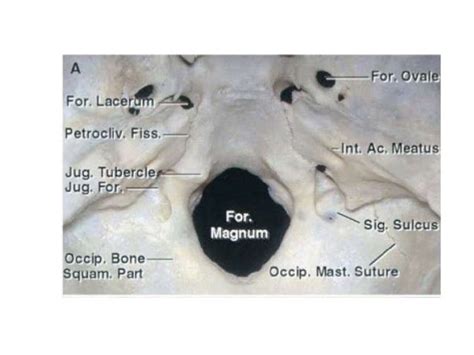 Jugular foramen anatomy and approaches