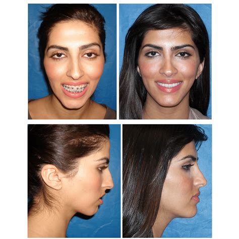 Before and After Photos Maxillofacial Surgery