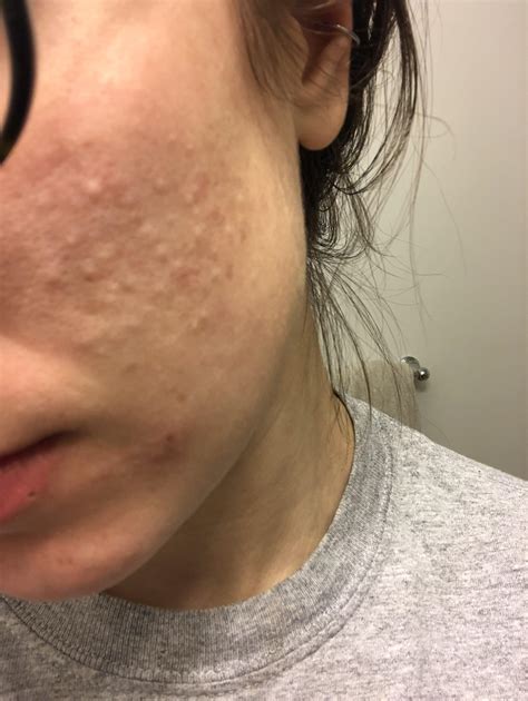 Help with pus-filled bumps on cheek! : r/acne