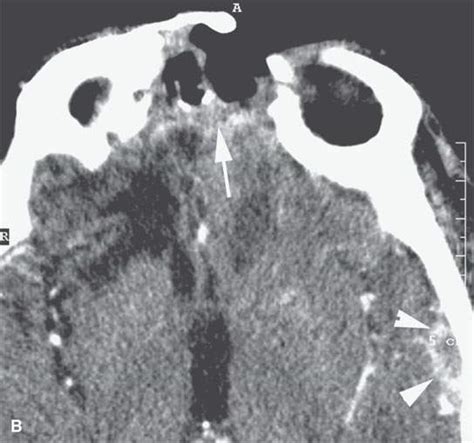 Benign and Malignant Neuroectodermal and Other Neurogenic Tumors ...