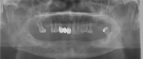 Dental CT scan vs. Cone Beam CT: an overview - ITI Blog