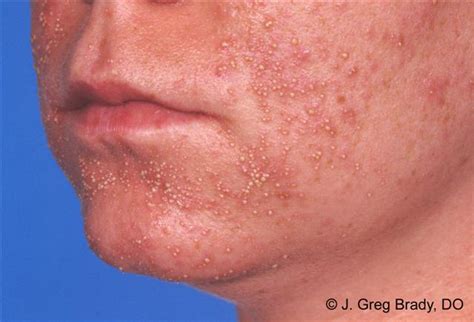 Acne Home Remedies For Dry Skin: Pseudomonas Folliculitis Home Remedies