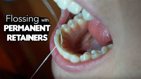 How To Floss with Permanent Retainer (Flossing Tricks) | Permanent ...