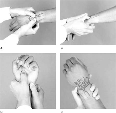 [PDF] Lunotriquetral Instability: Diagnosis and Treatment | Semantic ...