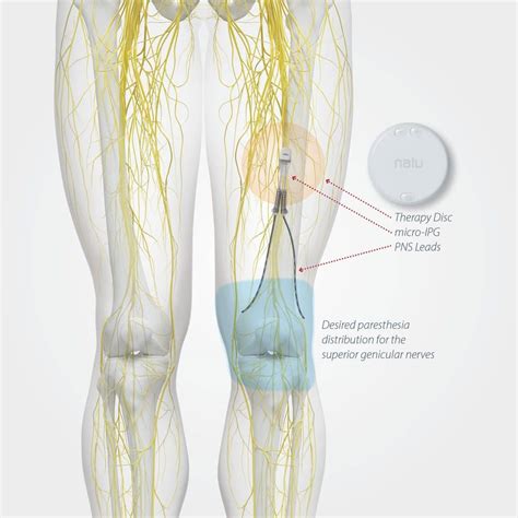 Peripheral Nerve Stimulation | Pain and Spine Specialists