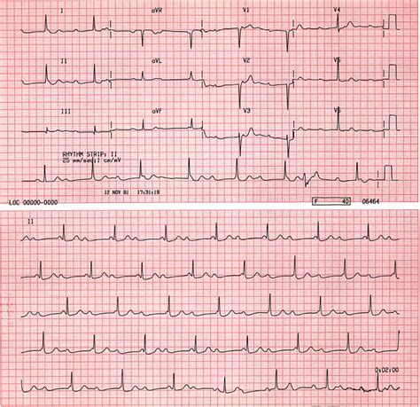 Case B7. Third Degree AV Block with Junctional Escape Rhythm. St Emlyn ...