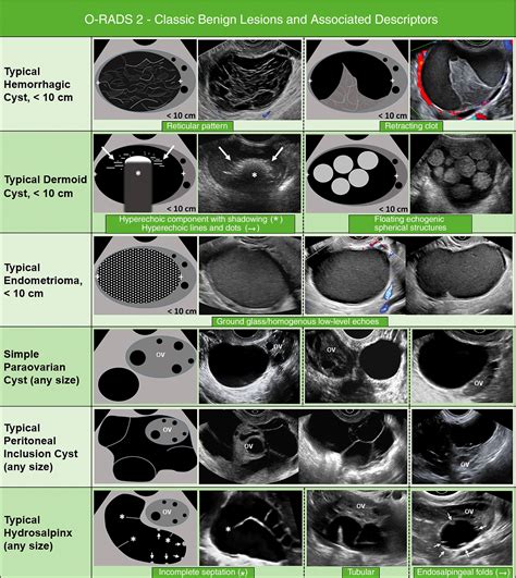 O-RADS Ultrasound Calculator - RadioGyan
