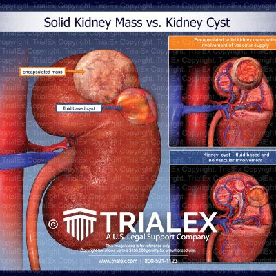 Solid Kidney Mass vs. Kidney Cyst - TrialExhibits Inc.