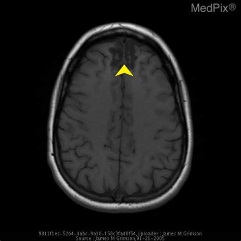 Traumatic brain injury MRI - wikidoc