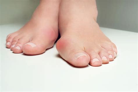 5 Foot Problems That Look Like a Bunion But Aren’t | Nagy Footcare