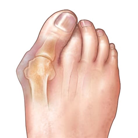 What Causes Bunions?