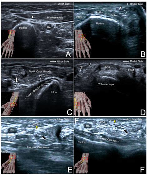 Ulnar Nerve Block Ultrasound