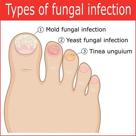 Cure Toenail Pain From Fungus Infection