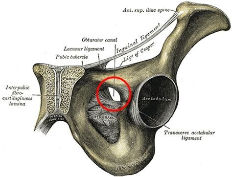 Obturator Hernia - The Operative Review Of Surgery