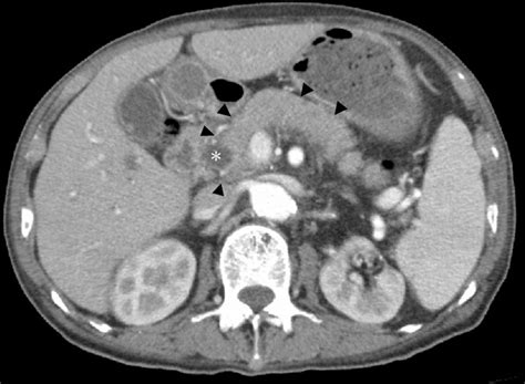 IgG4-related disease coexisting with autoimmune haemolytic anaemia | BMJ Case Reports