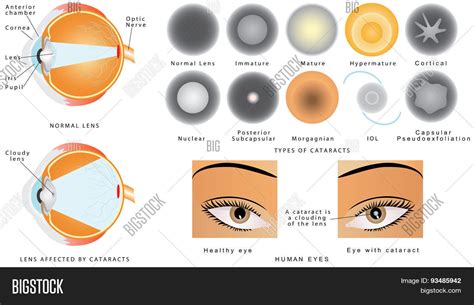 Cataract Vector & Photo (Free Trial) | Bigstock