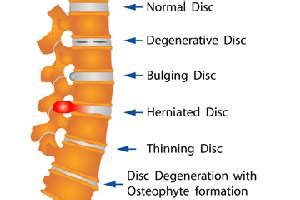 Lumbar Degenerative Disc Disease | Ultimate Things You Should Know