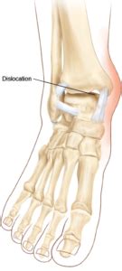 Ankle Dislocation Treatment | South Florida Podiatrist | Florida Foot & Ankle