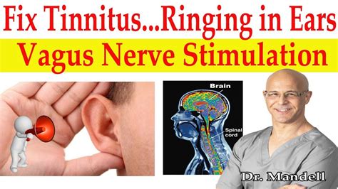 Fix Tinnitus (Ringing in Ears) Major Breakthrough How to Stimulate ...