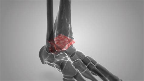 Ankle Fusion — Ankle Arthritis | Ankle Replacement | Arthrodesis | Ankle Fusion