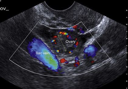 Doppler Ultrasound of the Female Pelvis | Radiology Key