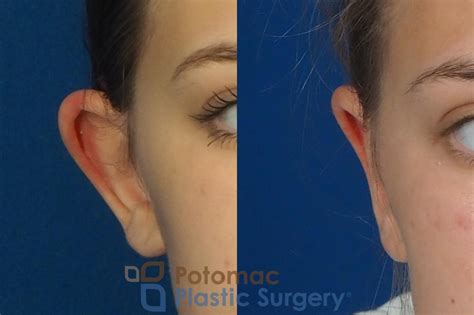 Otoplasty Before & After Photo Gallery | Washington, DC | Potomac Plastic Surgery