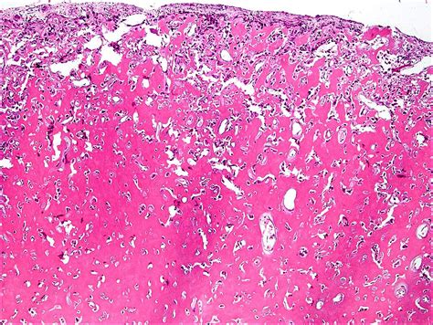 Osteoid Osteoma Histology