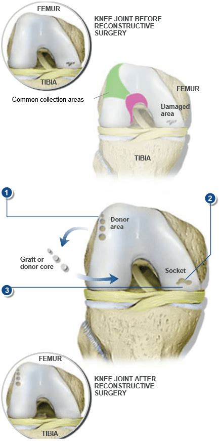 OATS Surgery | Dr. Patrick Chin Orthopedic Surgeon Vancouver