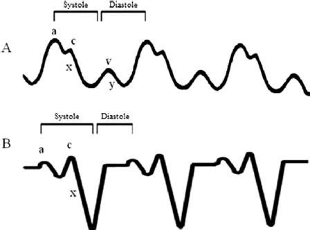 Download scientific diagram | CVP waveform in cardiac tamponade. (A) Normal CVP waveform. “a ...