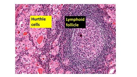 Hashimoto's Thyroiditis - Pathology Made Simple