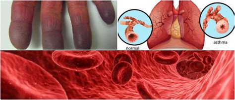 Hypoxemia Vs Hypoxia: Causes, Symptoms, and Treatment - Hoool Health ...