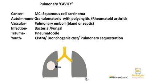 Causes Of Pulmonary Cavity - Visual Mnemonics - RadioGyan