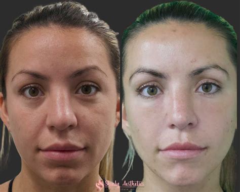 Under Eye Fillers - Before & After Results at Skinly