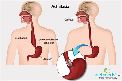 Achalasia: Causes, Symptoms And Treatment