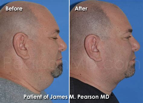 Submentoplasty / Cervicoplasty / Direct Neck Lift - Dr. James Pearson ...